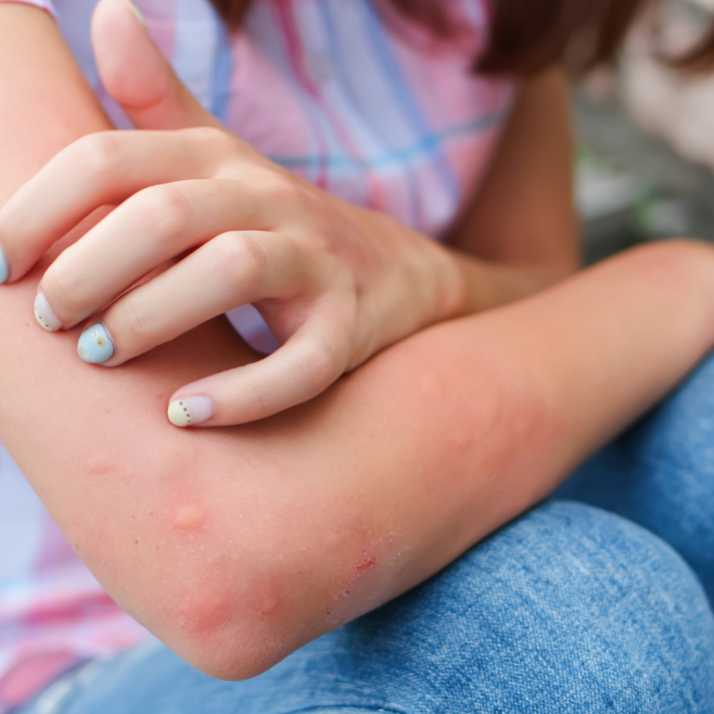 Children’s skin rashes, skin rashes, valvekliinik, skin